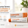 QUEIMADURAS LEVES: primeiros cuidados e como o QUEIMADOL pode auxiliar na recuperação da pele.